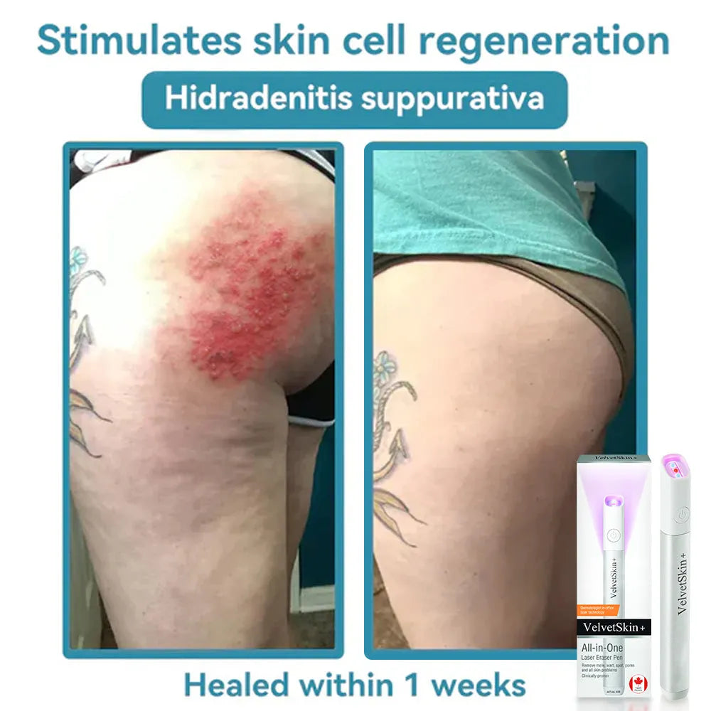 🔬qiawi™ All-in-one Co₂ Laser Eraser Pen | Removes Moles, Warts, Skin Flaws & Pigmentation